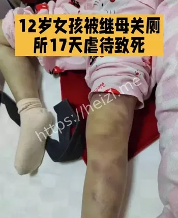 继母虐待女童